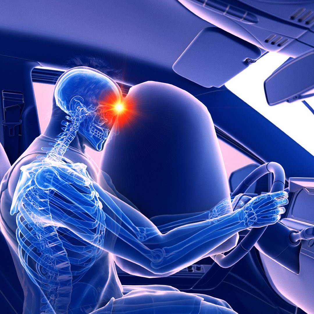 airbag injuries